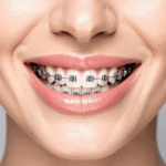 Orthodontic Treatment: Understanding Your Options for a Healthier, Straighter Smile