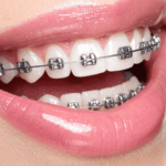 Understanding Braces: Types, Cost, Benefits, and What to Expect During Treatment