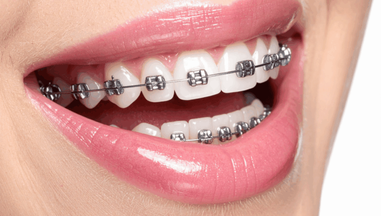 Understanding Braces: Types, Cost, Benefits, and What to Expect During Treatment