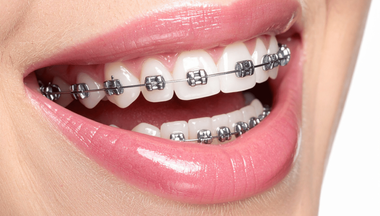 Understanding Braces: Types, Cost, Benefits, and What to Expect During Treatment
