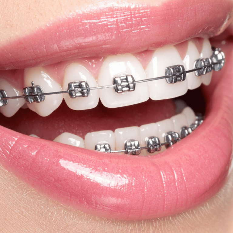 Understanding Braces: Types, Cost, Benefits, and What to Expect During Treatment