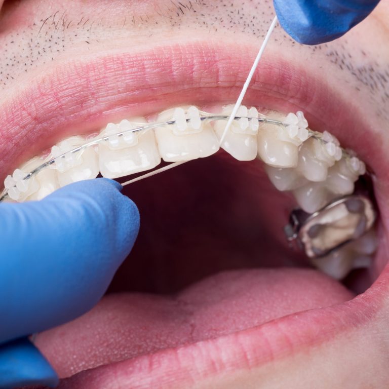 Dentist making hygiene teeth with ceramic brackets, using floss at the dental office. Macro shot of teeth with braces. Orthodontic Treatment. Oral hygiene and health care. Dentistry
